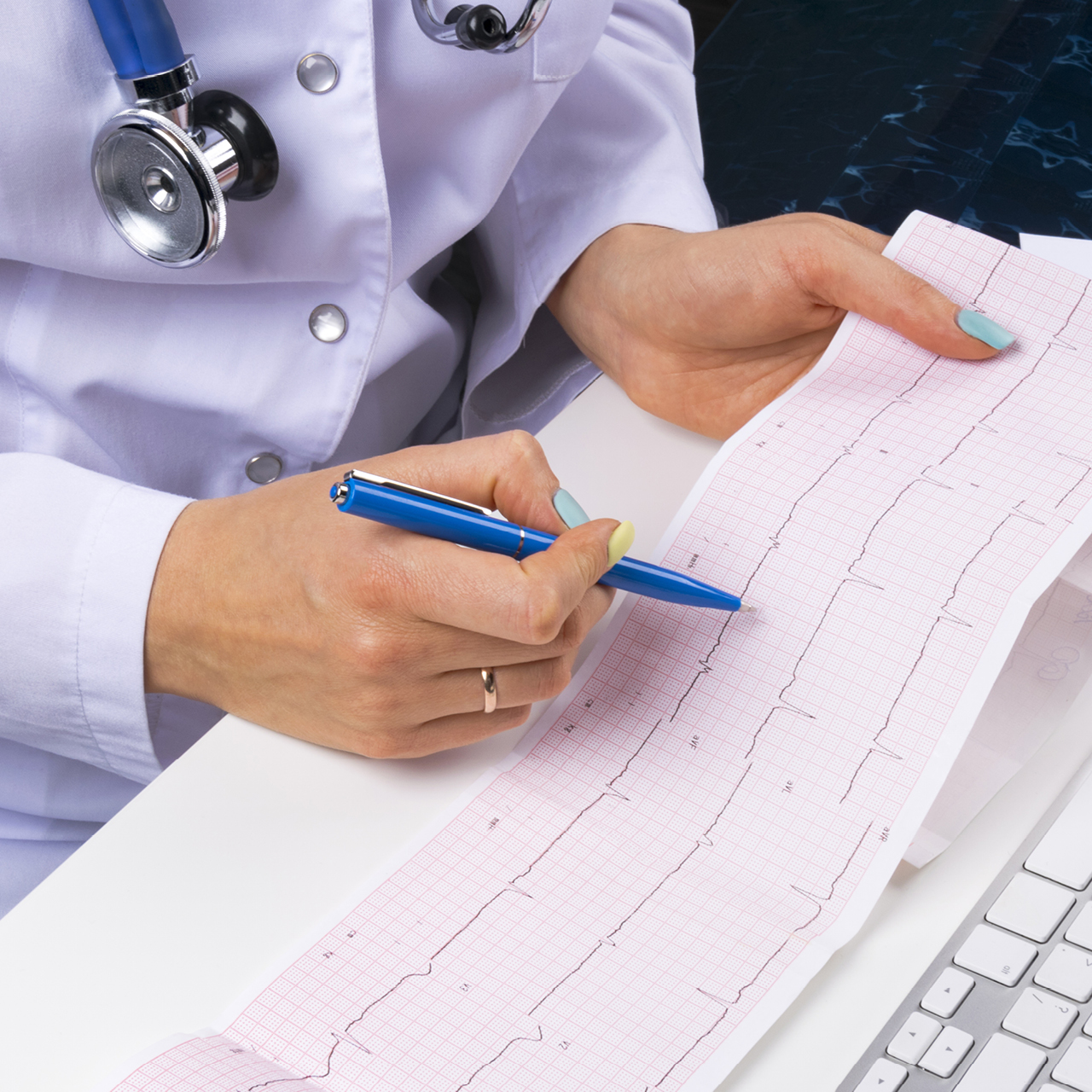 fibrillation auriculaire ecg