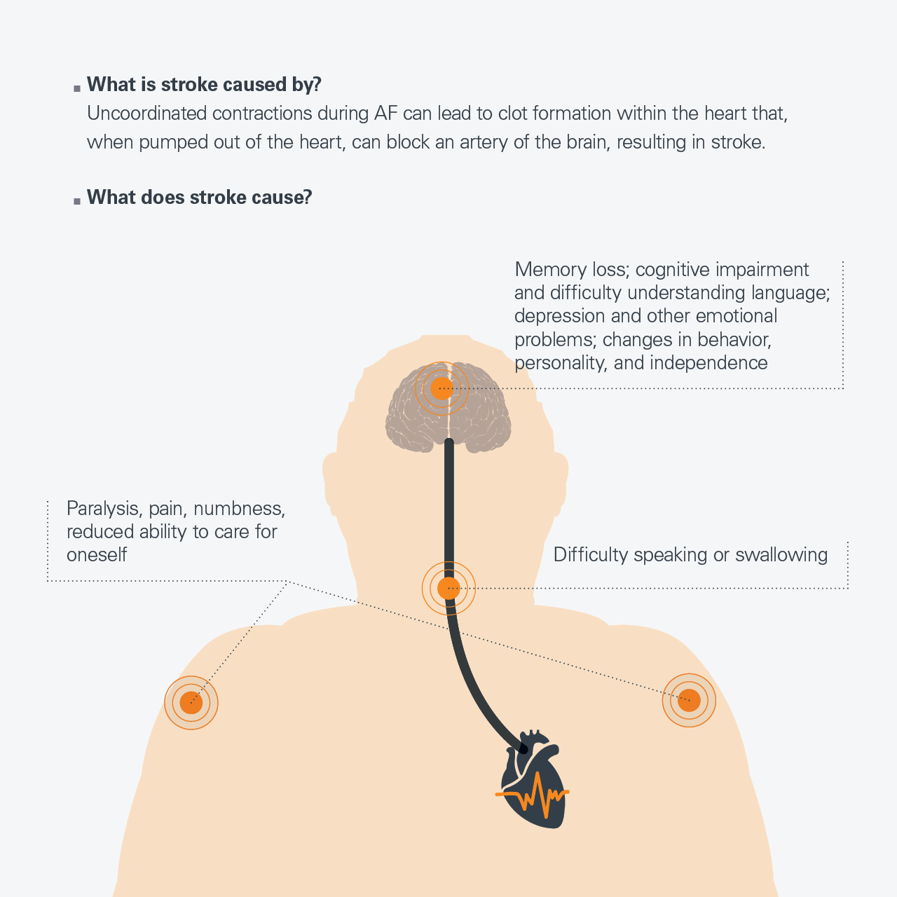 atrial fibrillation stroke risk