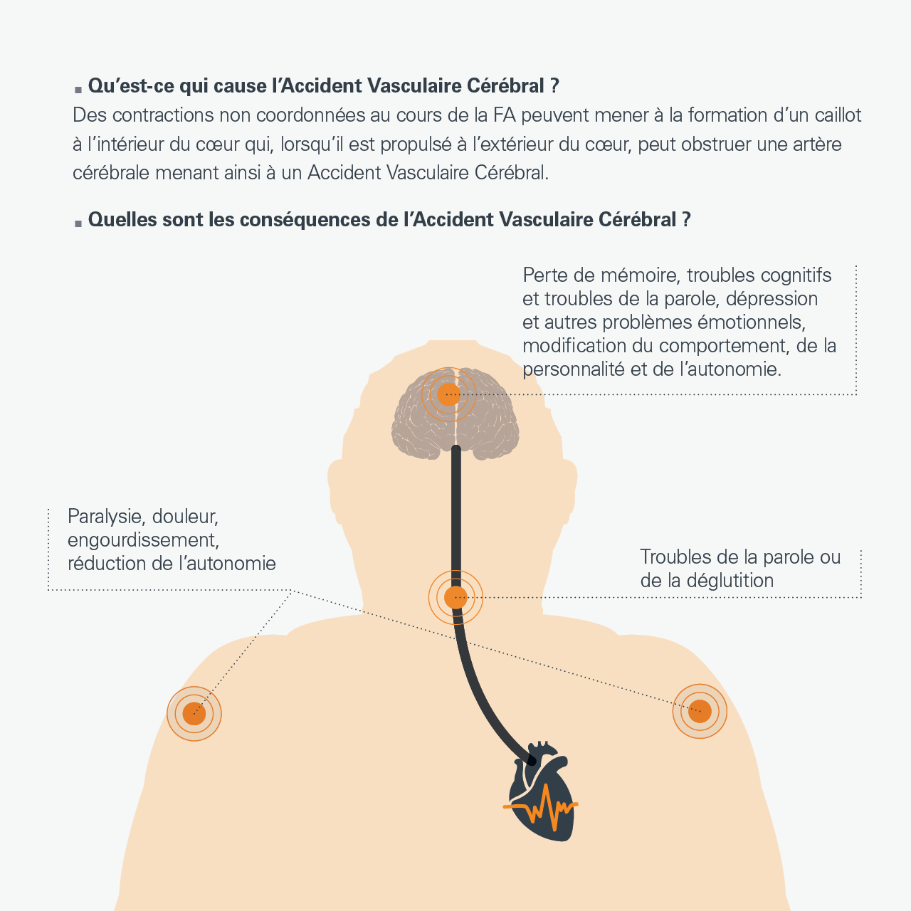 accident vasculaire cerebral