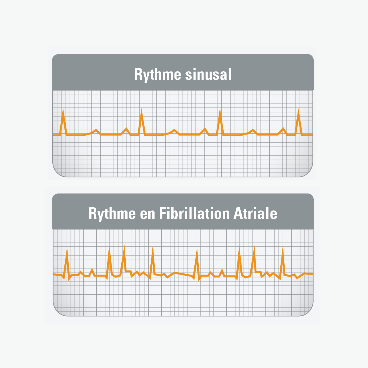 arythmie cardiaque par fibrillation auriculaire