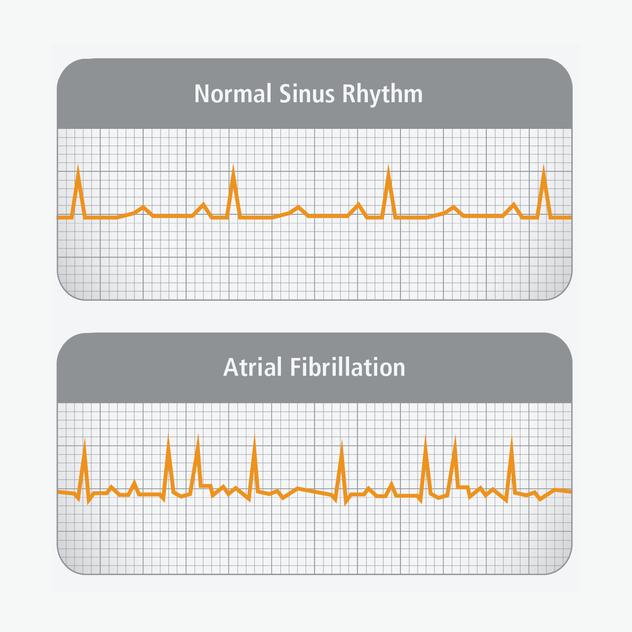 atrial fibrillation heart
