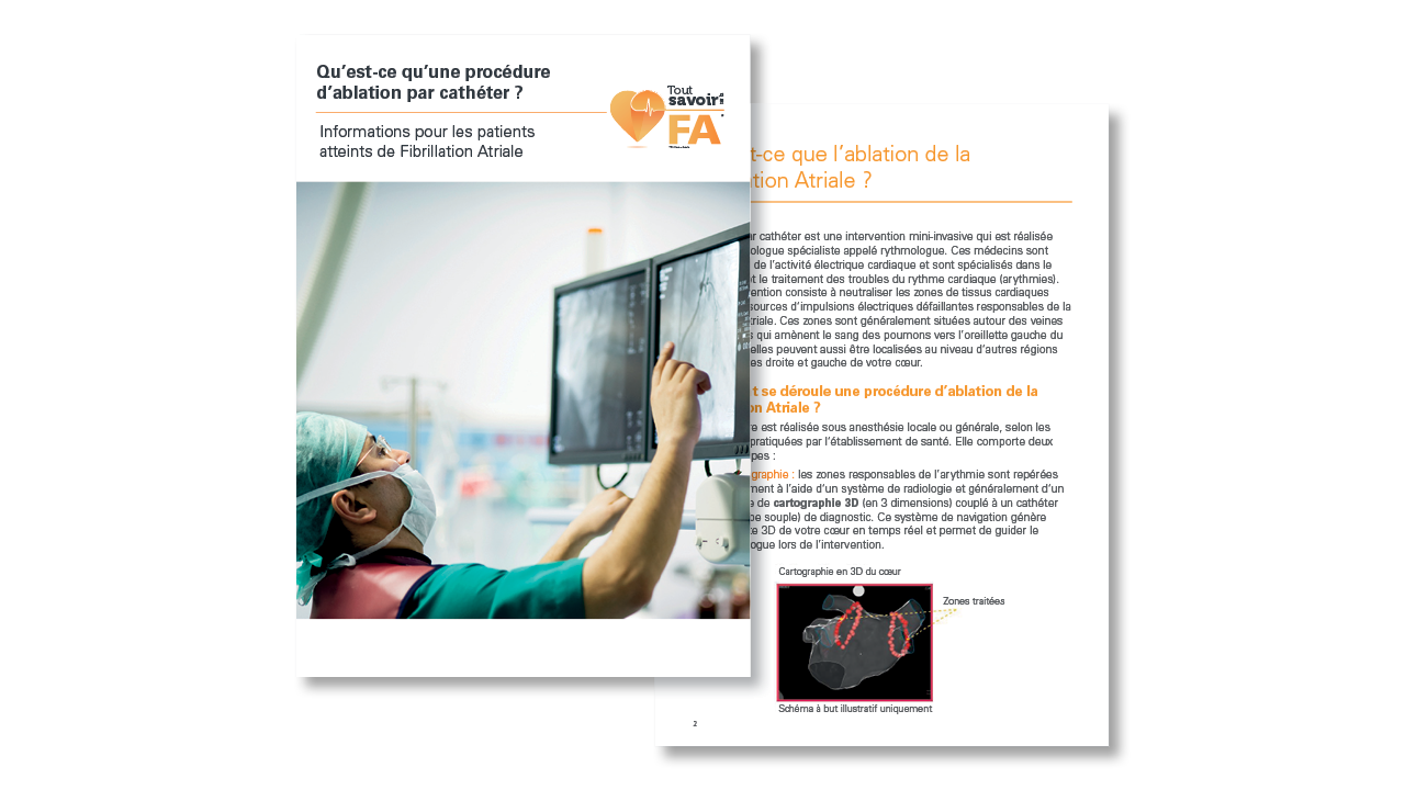 Informations pour les patients atteints de Fibrillation Atriale: Qu’est-ce qu’une procédure d’ablation par cathéter ?